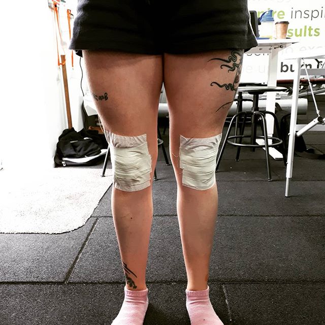 When you patella tracks medially…dominant VMO..that’s different!! @tobeawarrior #stafftraining #injury #injuryprevention #walkinglikeapenguin #taping #kneeproblems #kneelife #sportstherapy #massagetherapy #patellamaltracking #everydaysaschoolday